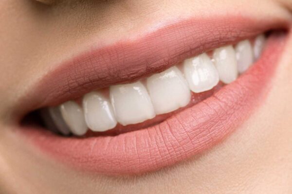 Lentes de contato dentais: veja os mitos mais comuns sobre o procedimento | Lifebrunch