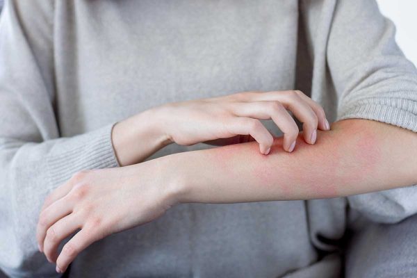 Alergias de pele: entenda as diferenças de cada uma e como tratá-las | Lifebrunch