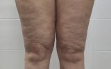 Lipedema: entenda a doença e como combatê-la com bons hábitos | Lifebrunch