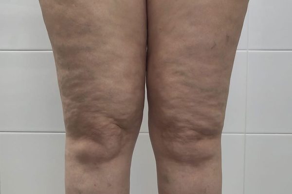 Lipedema: entenda a doença e como combatê-la com bons hábitos | Lifebrunch