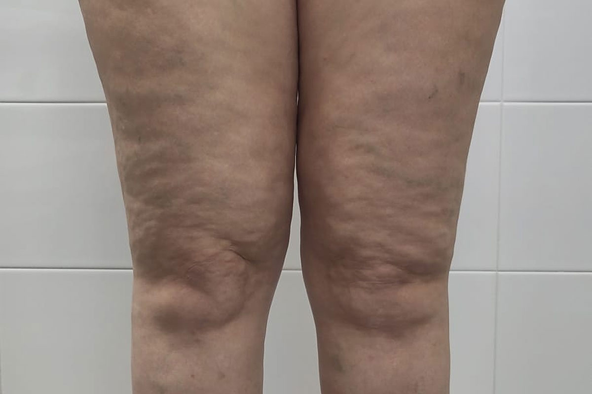 Lipedema: entenda a doença e como combatê-la com bons hábitos | Lifebrunch